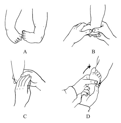 关于小儿“内翻足”的亲身经历，宝宝站不稳就一定是‘畸形’吗？