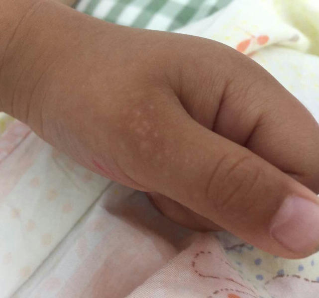 宝宝手背很多疹子,宝宝手背好多小包