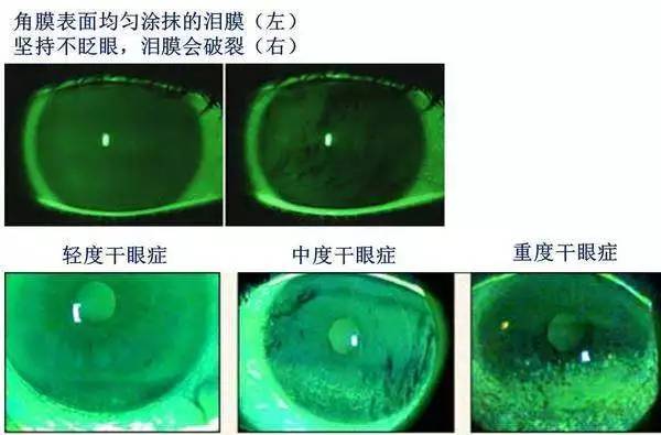 老板，近视是工伤！研究表明，越努力工作的人视力越差