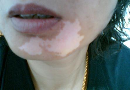 脸上的白癜风发展的太快好冶吗,在这个看脸的时代颜值有多重要