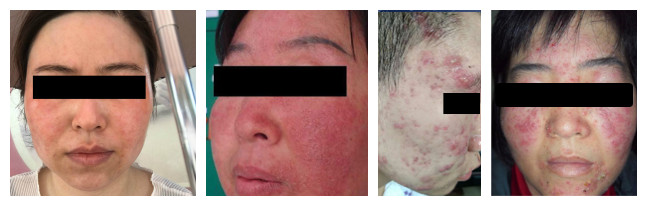 怎样判断自己是不是激素脸,如何判断激素脸和过敏脸