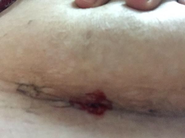 剖腹产伤口缝合和医生有关系吗,剖腹产刀口有个洞一直不愈合