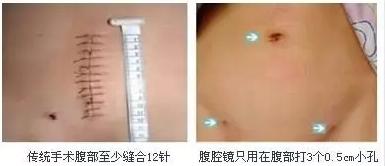 宿迁哪家医院可以做子宫肌瘤手术,做子宫肌瘤微创手术怎么恢复得快