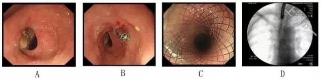 消化道穿孔诊治新进展,消化道穿孔内镜表现