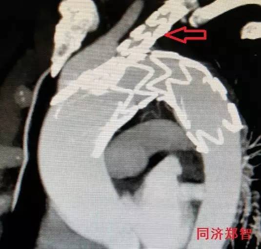 主动脉夹层差点要了老公的命,主动脉夹层兄妹