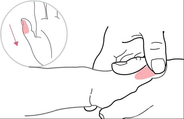 儿童扁桃体肥大切除手术后发烧,发烧引起扁桃体肿大要切除吗