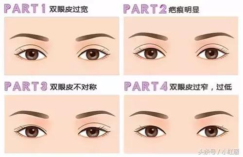 闺蜜割了双眼皮,割了双眼皮后悔了一个月