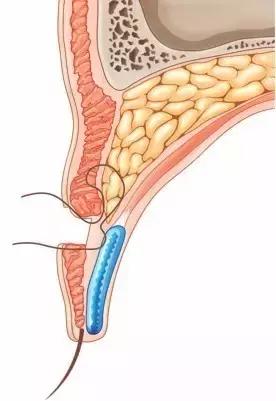拯救三眼皮的方法,术后出现三眼皮算手术失败吗