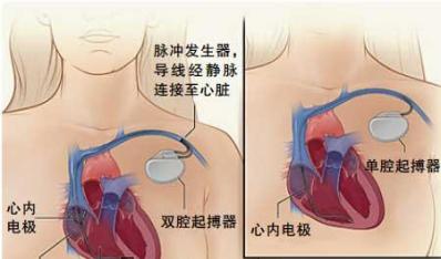 什么样的房颤需要抗凝治疗,房颤是药物治疗好还是手术治疗好