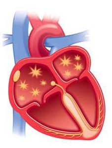 房颤消融能根治房颤吗,得了房颤怎么才能根治
