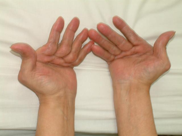 类风湿性关节炎的护理措施,类风湿性关节炎如何保护关节功能