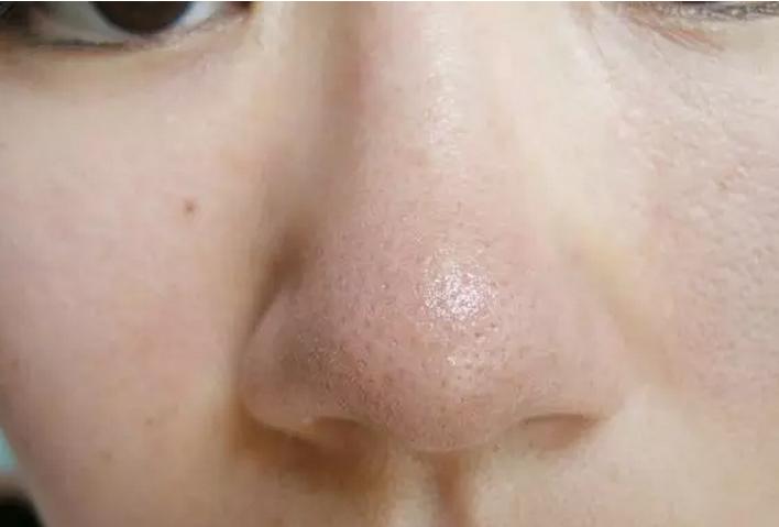 如何去黑头收缩毛孔最简单小方法,如何有效去黑头收缩毛孔小妙招