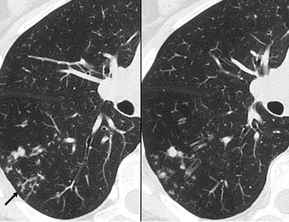 鸡呼吸道疾病用药,急性上呼吸道感染细菌感染用药