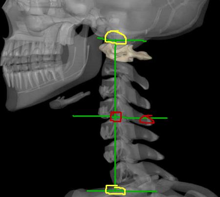一抬头脊椎疼怎么缓解,抬头颈椎疼如何缓解