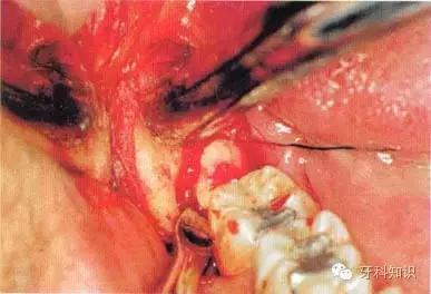 口腔拔牙图片,口腔拔牙麻醉多久消退