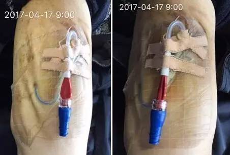 皮炎可以用的医用敷料,过敏性皮炎可以用医用敷料吗