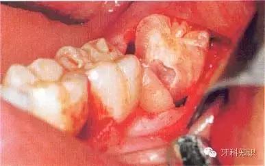 口腔拔牙图片,口腔拔牙麻醉多久消退