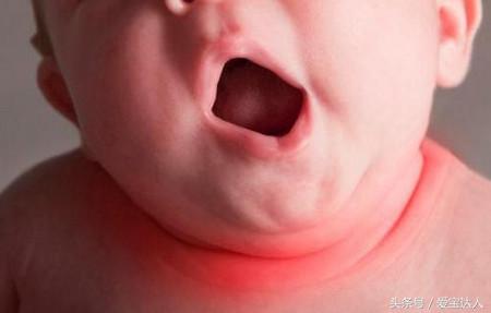 闷热天气小孩出汗怎么办,冬天宝宝淹脖子怎么办