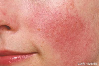 面对“阳光后遗症”，敏感肌肤该如何选择产品？