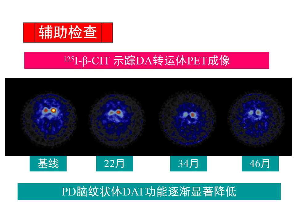 多图详解帕金森及运动障碍性疾病|关于帕金森最全的一个课件