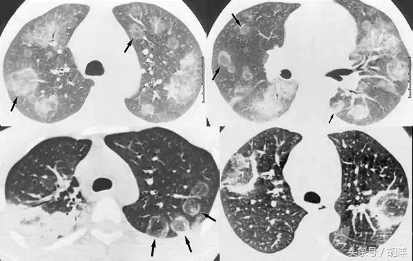 有一种真菌，专门在肺部原有疾病产生的空洞里长小球，消不掉，咳不出，有时候会引起致命大出血