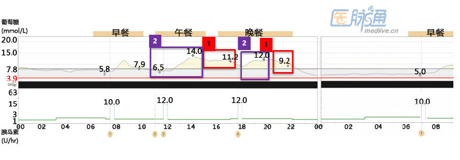 济南泉信｜怎样利用动态血糖监测仪调节胰岛素泵剂量？
