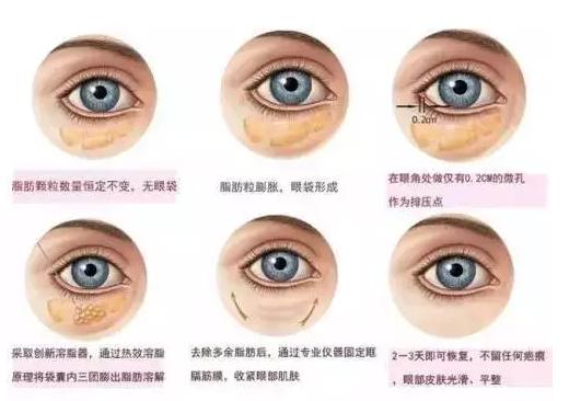 切除眼袋是唯一解决眼袋的方法,眼袋切除方法有哪些