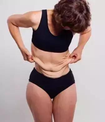 减肥后皮肤松弛跟肥胖纹怎么解决,瘦太快皮肤松弛出现肥胖纹怎么解