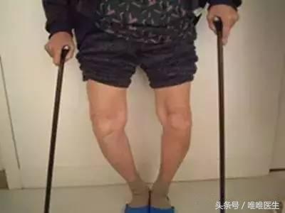 北京大学第一医院张道俭,讲解“走路不疼,上下楼疼”是肿么回事?