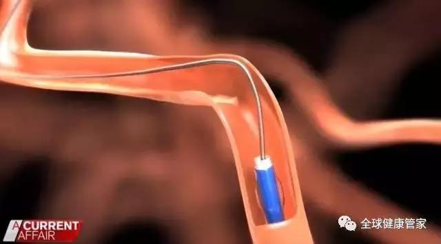 澳洲治疗中风可怕副作用,澳洲十大黑科技药