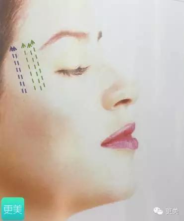 埋线美容线和不吸收线有什么区别,医院埋线和美容院埋线有什么差别