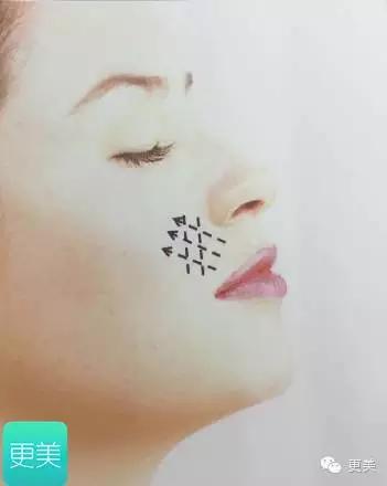 埋线美容线和不吸收线有什么区别,医院埋线和美容院埋线有什么差别