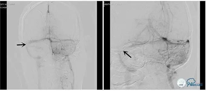 脑静脉窦狭窄做支架危险吗,静脉窦狭窄做支架后多久恢复