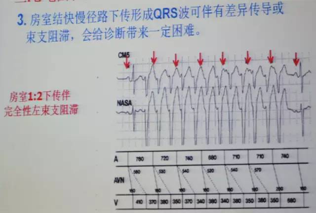 郭继鸿心电图学教程,郭继鸿异常心电图