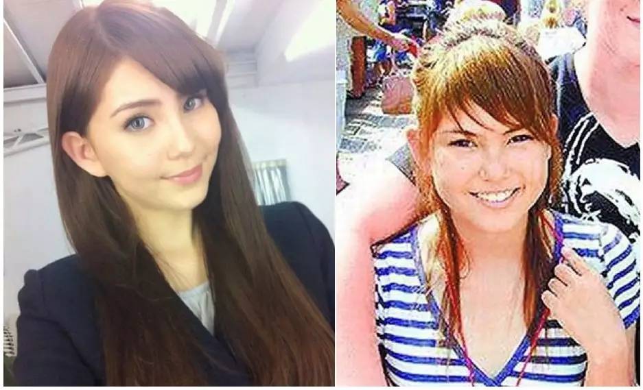 泪沟法令纹颈纹显老怎么办,改善泪沟法令纹全脸提升的方法