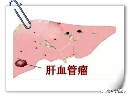 肝囊肿肝血管瘤肝内钙化灶,肝钙化血管瘤能治愈吗