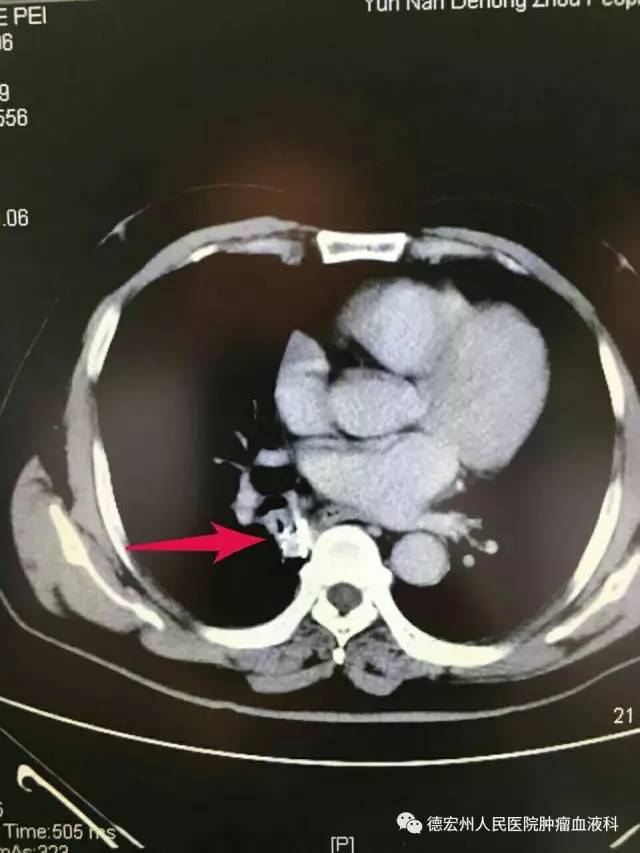 云南德宏中草药治癌,云南肿瘤医院治疗癌症