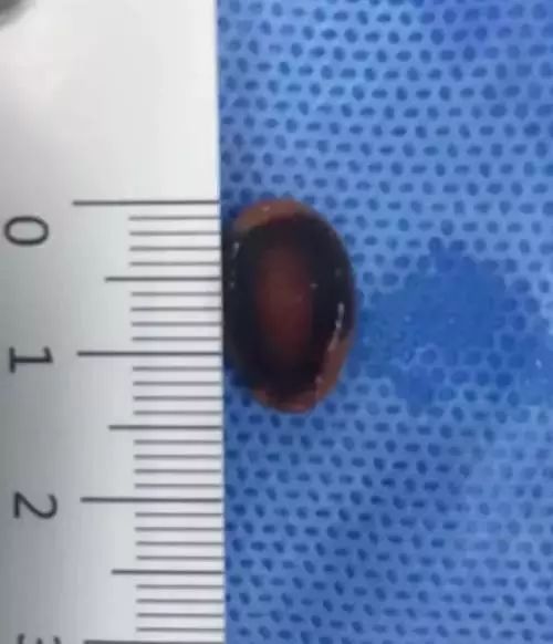 5岁小孩咳嗽了两个月了总是不好,6岁女童咳嗽要如何治疗