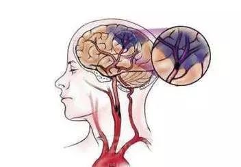 东莞中风救治定点医院,东莞治疗脑卒中最好的医院