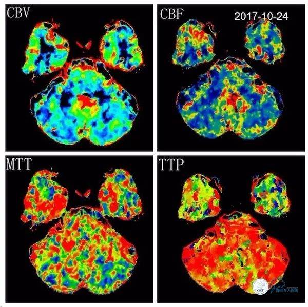 天坛医院脑血管狭窄手术做得好吗,天坛医院动脉狭窄介入手术费用