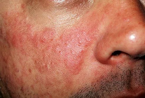 免疫系统出了问题是什么病,免疫系统出了问题会得什么病