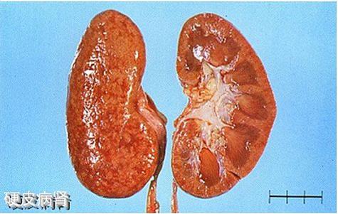 下巴长痘是清热解毒还是祛湿,下巴发黑长痘是不是体内有毒素