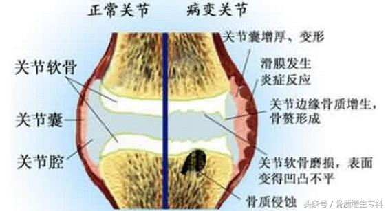膝关节骨质增生正确锻炼方法,膝关节骨质增生可以骑单车锻炼么
