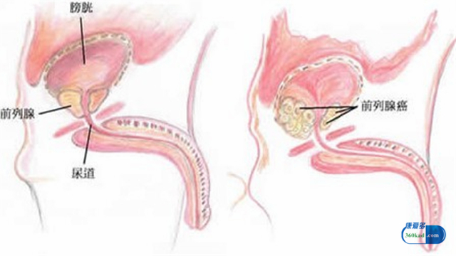 前列腺癌吃比卡鲁胺的副作用,前列腺癌吃比卡鲁胺片能治好吗