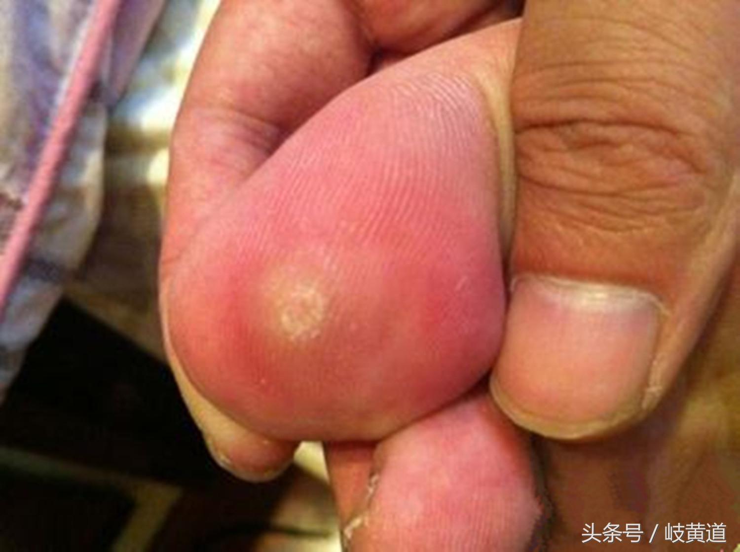 鸡眼总是不好怎么办,中医鸡眼是怎么回事