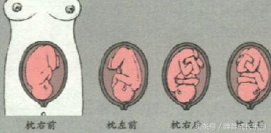 胎位扭转术有什么风险,39周胎位倒转术还可以做吗