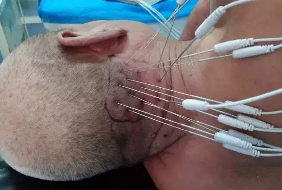 射频消融术和内热针有什么区别,内热针疗法治疗腰间盘突出