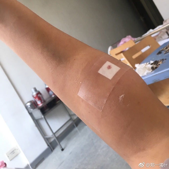 不小心吃了福寿螺怎么办,吃到福寿螺头晕恶心怎么办