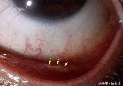 养猫会导致人得脑膜炎吗,养猫会让人得脑瘤吗