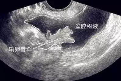 盆腔积液会导致不孕吗？要怎么才能治好？